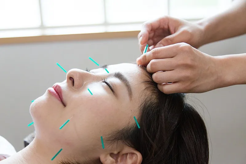 美容鍼